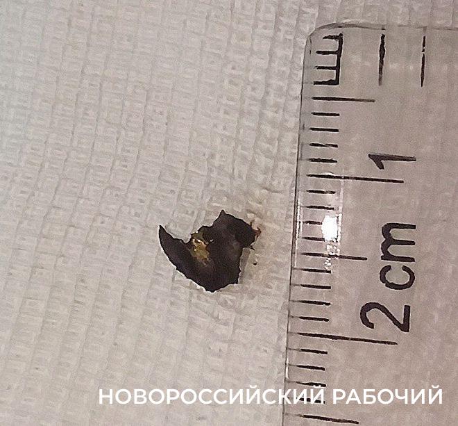 В Новороссийске медики вытащили магнитом из глаза пациента инородное тело