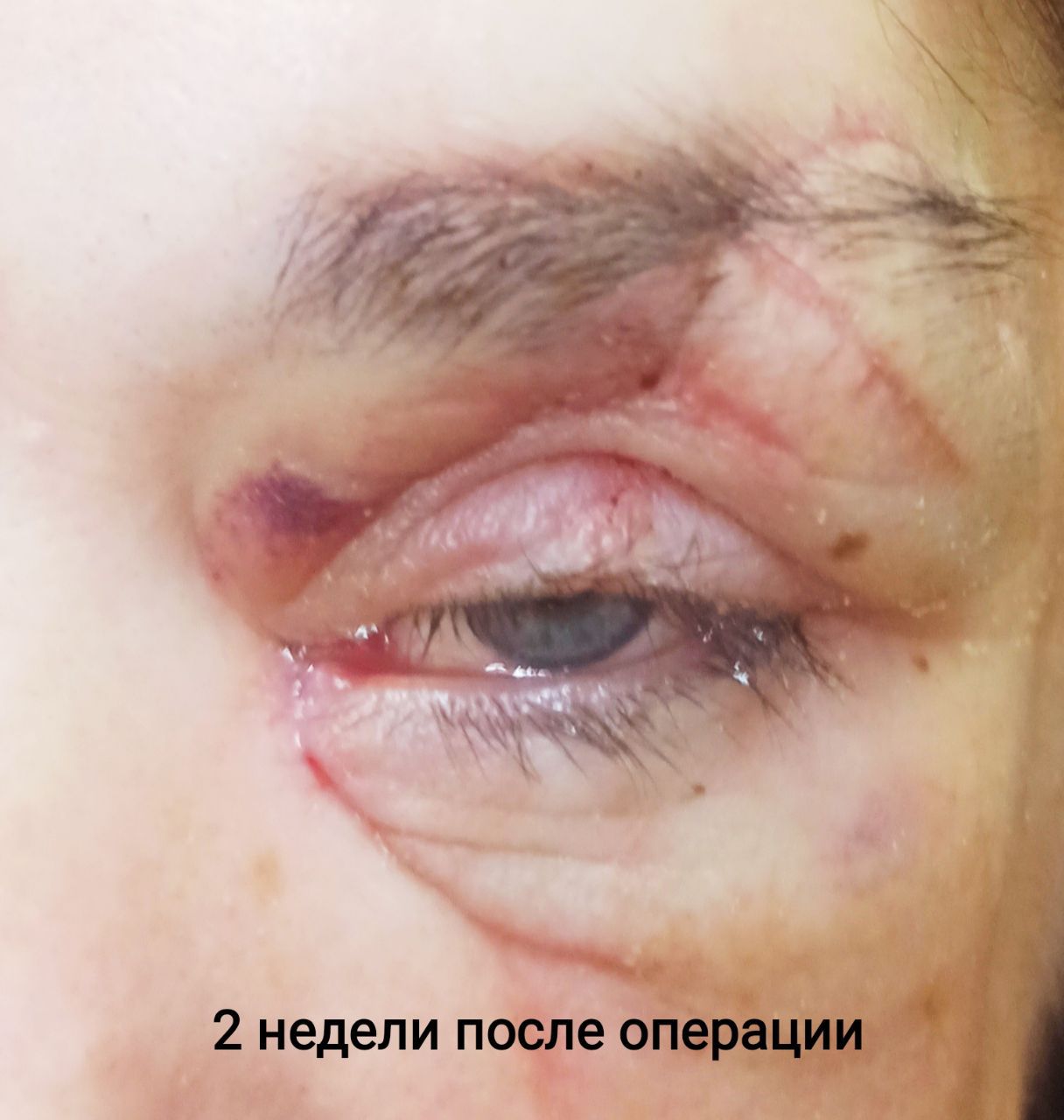В Новороссийске медики сшили порезанные веки молодой женщины